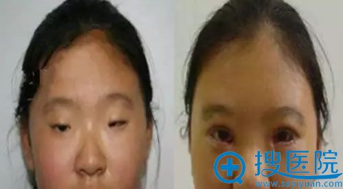 南充韩美小眼裂综合症修复案例 南充韩美小眼裂综合症修复案例