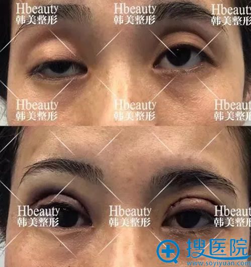 南充韩美重度上睑下垂修复案例 南充韩美重度上睑下垂修复案例