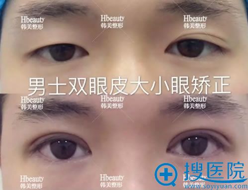 南充韩美男士双眼皮大小眼矫正案例 南充韩美男士双眼皮大小眼矫正案例