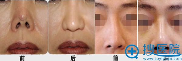 沈干隆鼻失败修复案例 沈干隆鼻失败修复案例