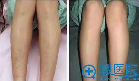如何悄悄变美?南宁科医美告诉您这个季节适合做哪些微整项目