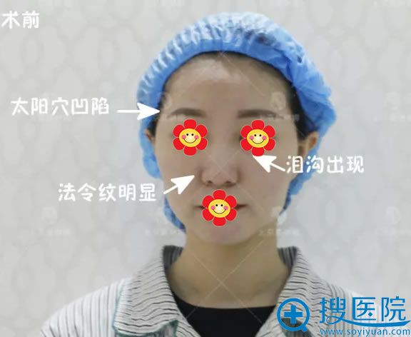 在莫琳娜做自体脂肪填充前照片 在莫琳娜做自体脂肪填充前照片