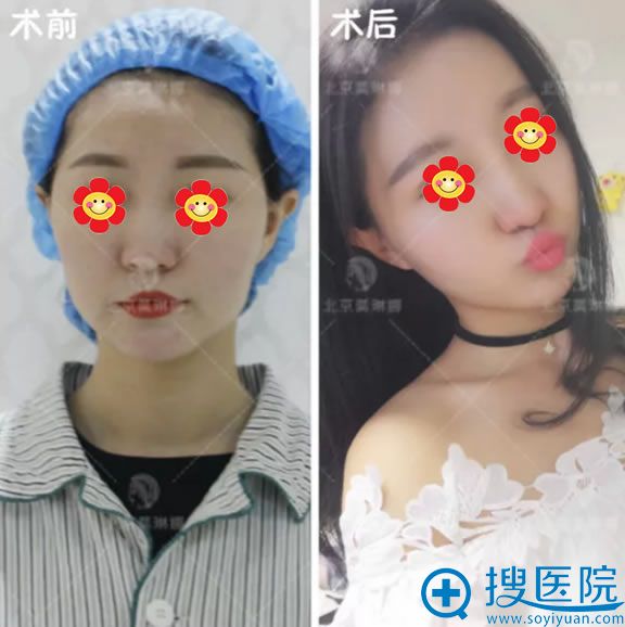 <!--<i data=20240710 data-id=12446></i>-->脂肪填充案例前后效果对比图 <!--<i data=20240710 data-id=12446></i>-->脂肪填充案例前后效果对比图