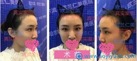 选择哈尔滨欧兰仁美李功哲达拉斯隆鼻术真是太对了,术后很美哦