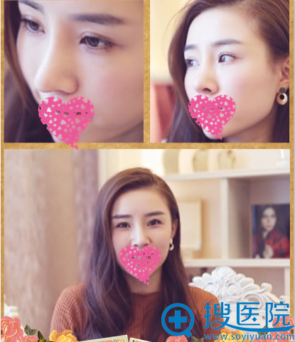李功哲达拉斯隆鼻术后效果 李功哲达拉斯隆鼻术后效果