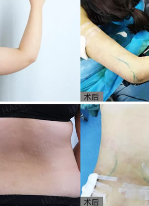 昆明韩辰27岁整形咨询师亲自体验了一把胡乔院长腰腹手臂吸脂术
