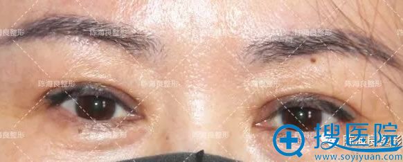 双眼皮手术20天到一美复查照片 双眼皮手术20天到一美复查照片