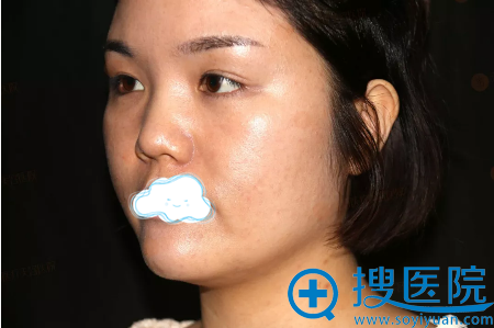 郑州天后王永功不让我垫高鼻梁 改做膨体鼻综合术后效果真不错