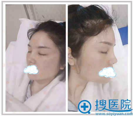 王永功膨体鼻综合术后即刻效果 王永功膨体鼻综合术后即刻效果