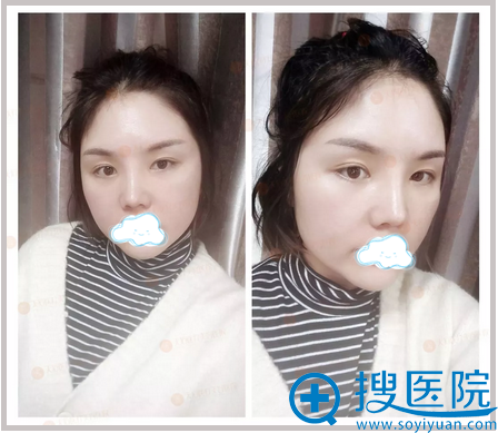 <!--<i data=20240710 data-id=12037></i>-->鼻综合术后7天照片 <!--<i data=20240710 data-id=12037></i>-->鼻综合术后7天照片