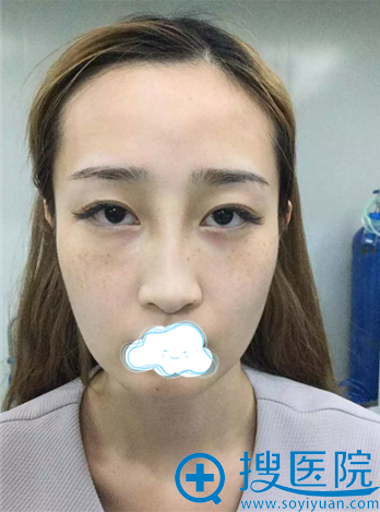 小妍干瘪苍老的术前照 小妍干瘪苍老的术前照