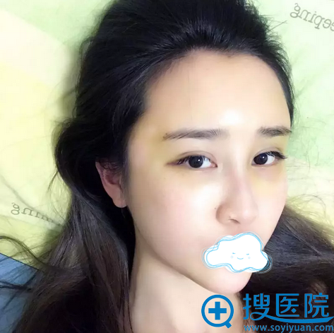 深圳南西子脂肪填充面部术后5天 深圳南西子脂肪填充面部术后5天