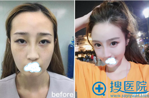 深圳南西子脂肪填充面部对比照 深圳南西子脂肪填充面部对比照