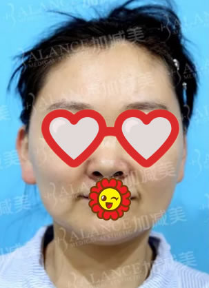 北京加减美整形黄寅守2个月前帮我做了V美瘦脸波纹式颧骨缩小术