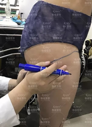 半个月前在南宁韩成整形李宁处做了大腿吸脂手术 记录恢复过程