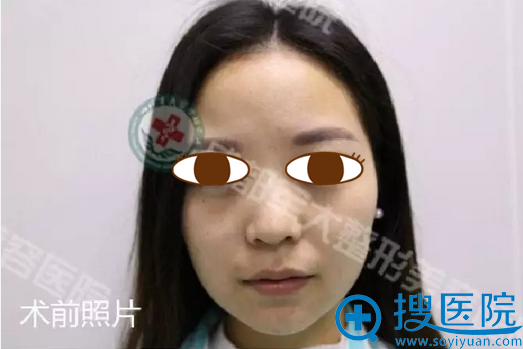 术前两颊有肉鼻子塌 术前两颊有肉鼻子塌