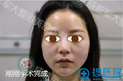 线雕V脸+线雕隆鼻术后即刻效果 线雕V脸+线雕隆鼻术后即刻效果