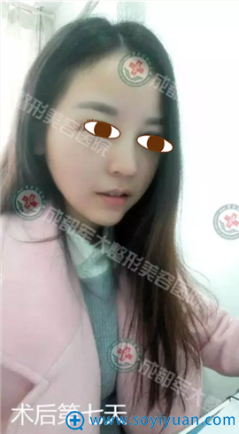 <!--<i data=20240710 data-id=15150></i>-->周斌线雕小V脸术后效果 <!--<i data=20240710 data-id=15150></i>-->周斌线雕小V脸术后效果