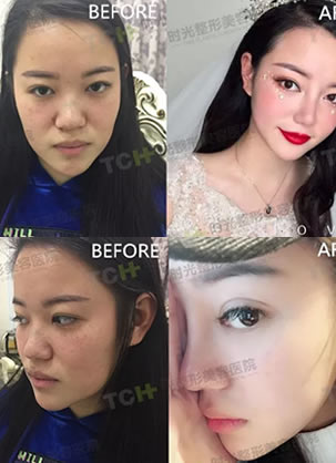 安利一个重庆时光陈玉连院长耳软骨+鼻中隔+假体隆鼻综合案例