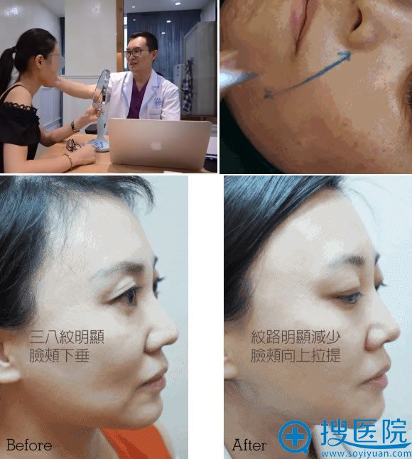 路世敏教授线雕手术过程及真人案例 路世敏教授线雕手术过程及真人案例