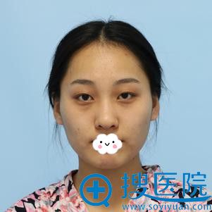 我到西安美莱准备做双眼皮手术之前 我到西安美莱准备做双眼皮手术之前