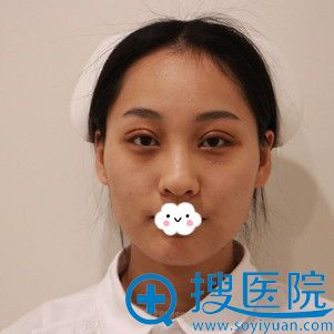 西安美莱王鹏双眼皮案例术后5天 西安美莱王鹏双眼皮案例术后5天