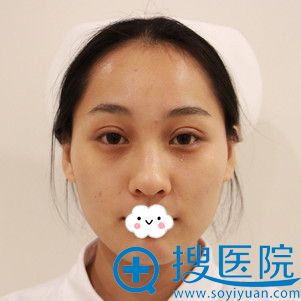 西安美莱王鹏双眼皮案例术后22天 西安美莱王鹏双眼皮案例术后22天