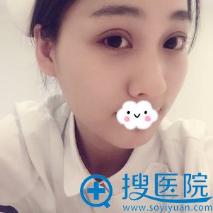 西安美莱王鹏双眼皮案例术后155天 西安美莱王鹏双眼皮案例术后155天