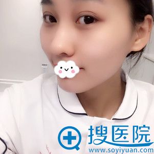 西安美莱王鹏双眼皮案例术后287天 西安美莱王鹏双眼皮案例术后287天