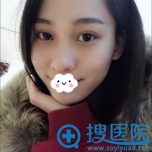 西安美莱王鹏双眼皮案例术后380天.jpg 西安美莱王鹏双眼皮案例术后380天.jpg