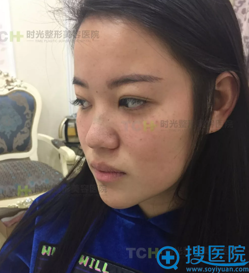 崔崔做鼻综合手术前的塌鼻照片 崔崔做鼻综合手术前的塌鼻照片