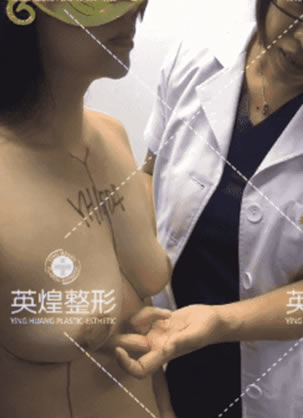 30出头的我选择北京英煌项力源主任做自体脂肪隆胸的理由及效果
