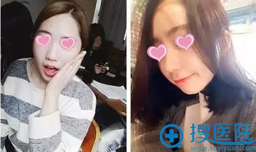 常州美贝尔假体综合隆鼻案例对比图 常州美贝尔假体综合隆鼻案例对比图