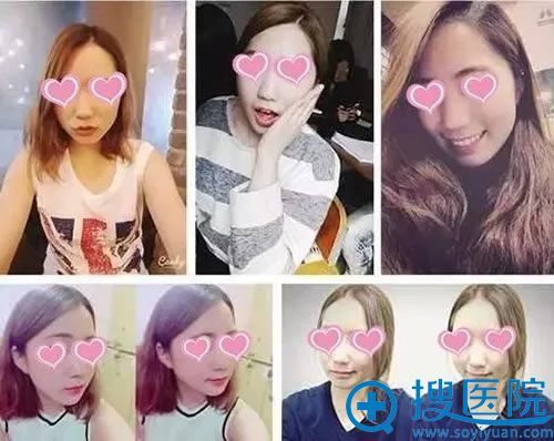 选择美贝尔做隆鼻手术前的样子 选择美贝尔做隆鼻手术前的样子