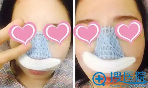 假体隆鼻手术当天的效果图 假体隆鼻手术当天的效果图