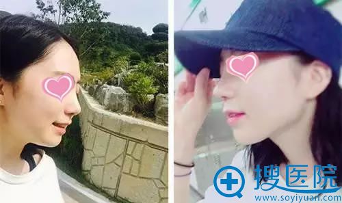 常州美贝尔鼻综合整形7天效果 常州美贝尔鼻综合整形7天效果