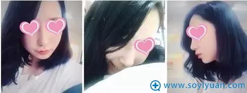 鼻综合第14天效果图 鼻综合第14天效果图