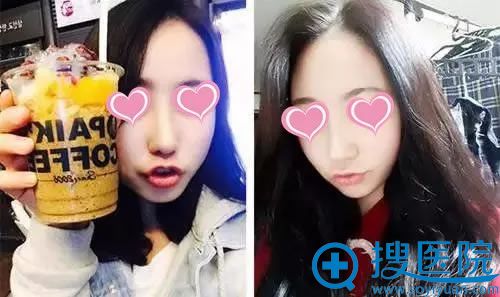 假体鼻综合手术1个月恢复图片 假体鼻综合手术1个月恢复图片