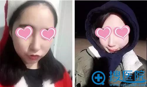 鼻综合手术5个月恢复好的照片 鼻综合手术5个月恢复好的照片