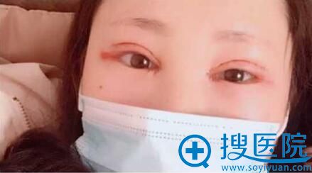 合肥壹加壹<!--<i data=20240710 data-id=16585></i>-->双眼皮术后1天 合肥壹加壹<!--<i data=20240710 data-id=16585></i>-->双眼皮术后1天