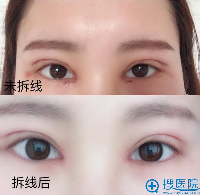 合肥壹加壹<!--<i data=20240710 data-id=16585></i>-->双眼皮术后7天 合肥壹加壹<!--<i data=20240710 data-id=16585></i>-->双眼皮术后7天