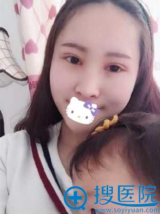 合肥壹加壹<!--<i data=20240710 data-id=16585></i>-->双眼皮术后9天 合肥壹加壹<!--<i data=20240710 data-id=16585></i>-->双眼皮术后9天