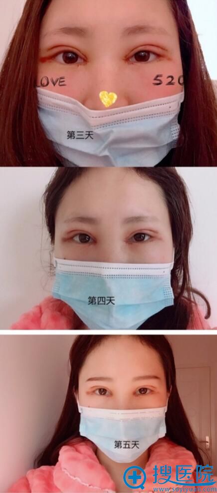 合肥壹加壹<!--<i data=20240710 data-id=16585></i>-->双眼皮术后3-5天 合肥壹加壹<!--<i data=20240710 data-id=16585></i>-->双眼皮术后3-5天