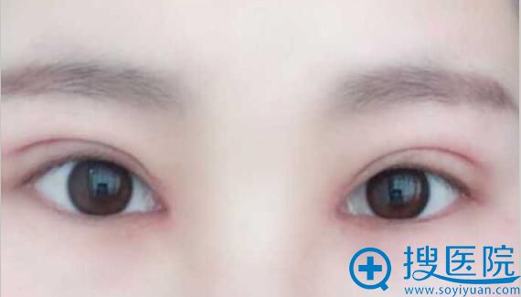 合肥壹加壹<!--<i data=20240710 data-id=16585></i>-->双眼皮术后15天 合肥壹加壹<!--<i data=20240710 data-id=16585></i>-->双眼皮术后15天