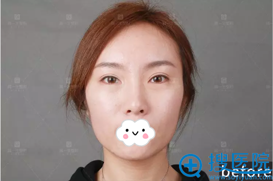 免费在西安高一生体验玻尿酸丰苹果肌丰下巴 金磊院长技术真赞