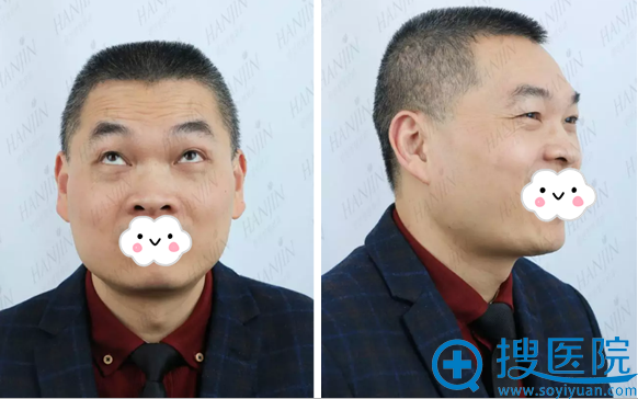 一针轻松解决抬头纹鱼尾纹 昆明韩辰尹东方去皱7天对比照