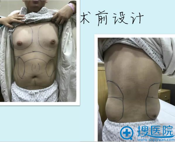 决定公开我让重庆星宸的石冰院长做水动力腰腹吸脂的真实经历
