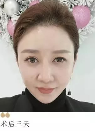 好姐妹推荐说青岛壹美的口碑不错 看我打完3天后的图片