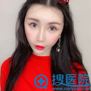 注射玻尿酸填充鼻唇沟第2天 注射玻尿酸填充鼻唇沟第2天