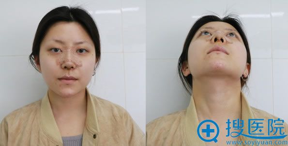 做隆鼻手术第3天恢复效果图 做隆鼻手术第3天恢复效果图